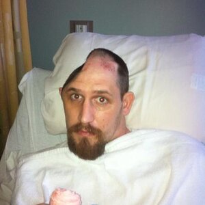 2012TBI (traumatic brain injury) fyi I was worse than this! (This was months into my recovery)Almost didn't make 33! & now have a spyder to enjoy. THA